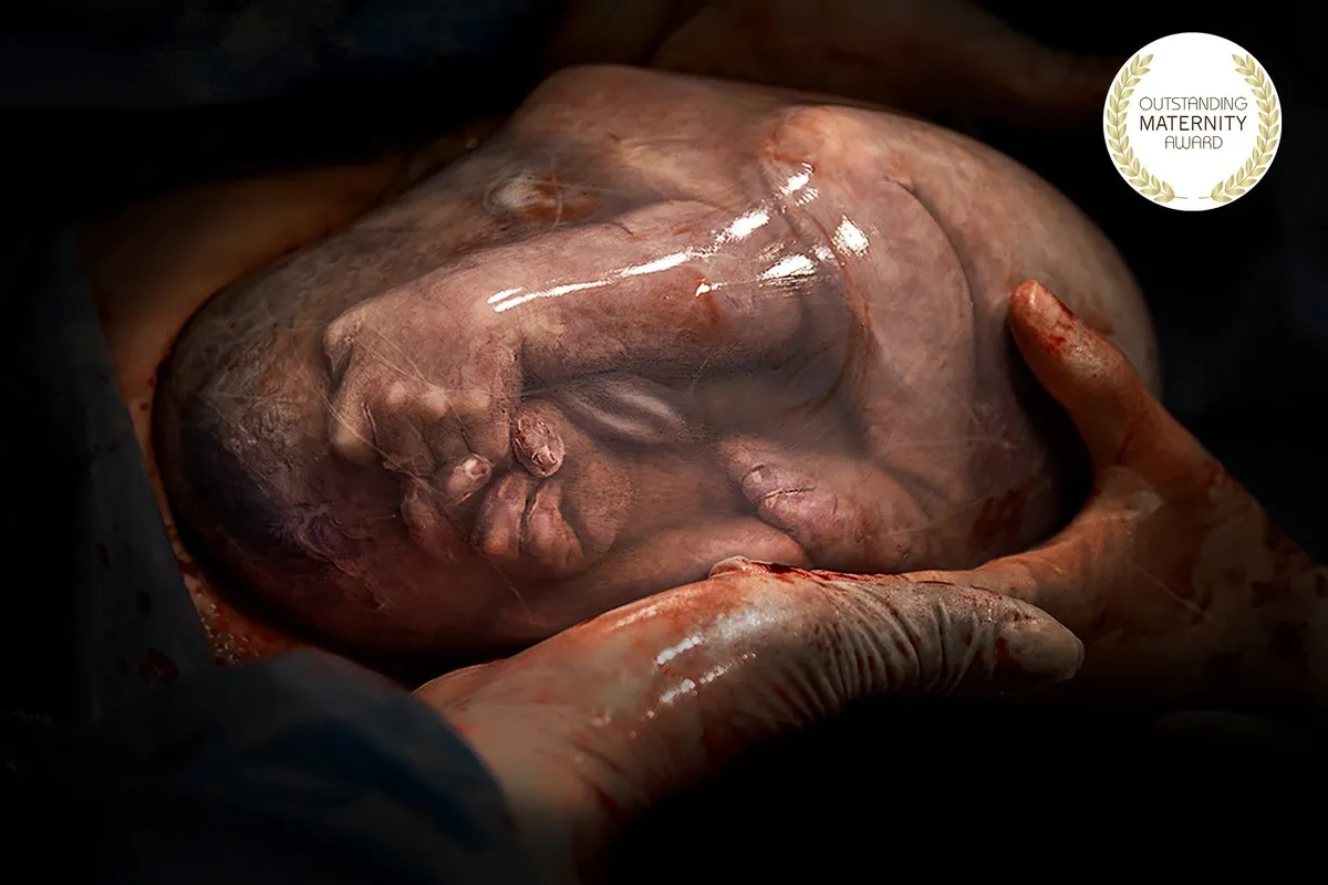 Foto premiada: Outstanding Maternity Award, Temporada 26 · Parto empelicado