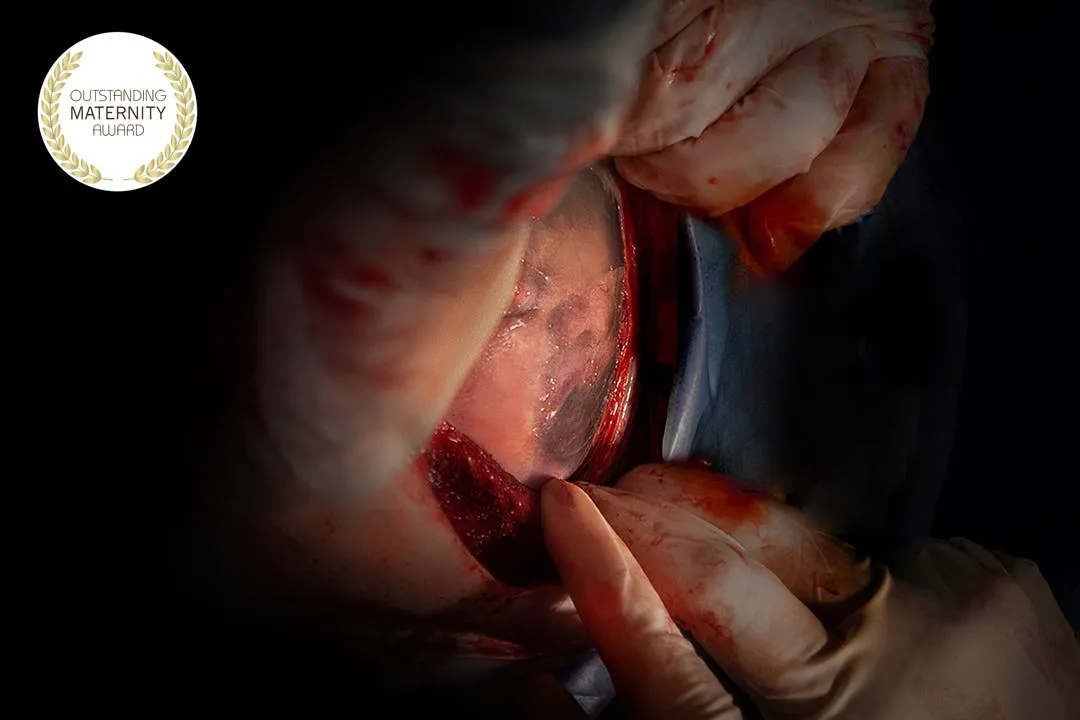 Foto premiada: Outstanding Maternity Award, Temporada 31 · Parto empelicado